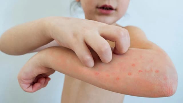 Skuteczne sposoby na wysypkę u dziecka – co warto wiedzieć? Skuteczne sposoby na wysypkę u dziecka – co warto wiedzieć?