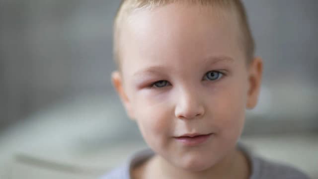 Co na opuchnięte oko u dziecka? Skuteczne sposoby i porady Co na opuchnięte oko u dziecka? Skuteczne sposoby i porady